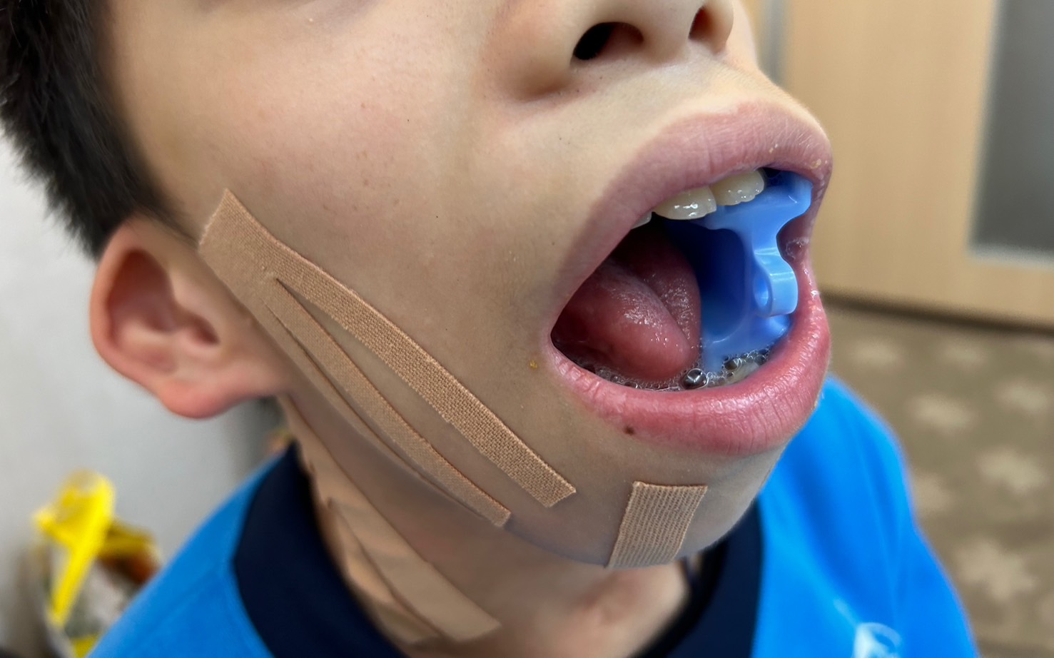 【自由時報】腦麻童吃東西常嗆到 吞嚥治療助安全進食(標題圖檔)